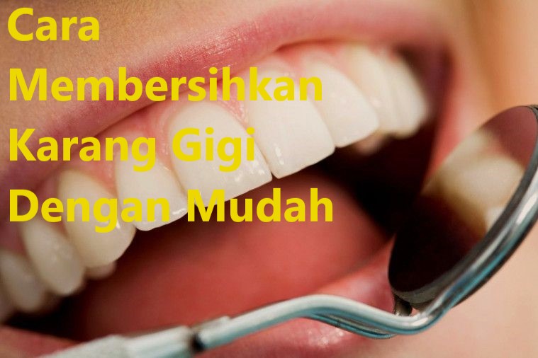 Cara Membersihkan Karang Gigi Dengan Mudah